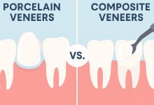 porcelain-veneers-vs.-composite-veneers:-which-is-right-for-you